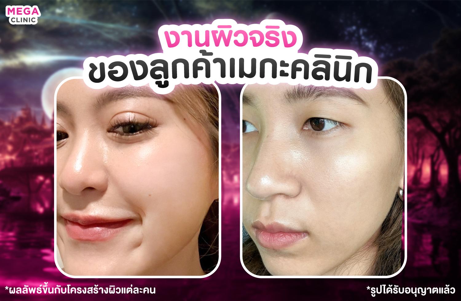 ผิวหน้า Glass Skin เมกะ คลินิก