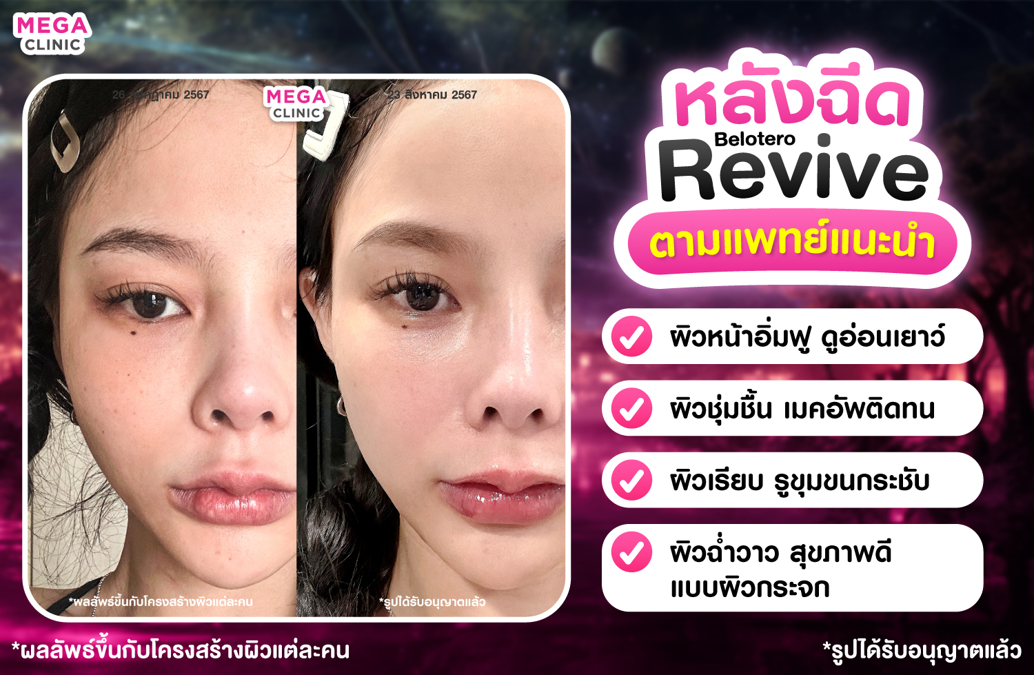 รีวิวผิวกระจก ฟิลเลอร์ Belotero Revive