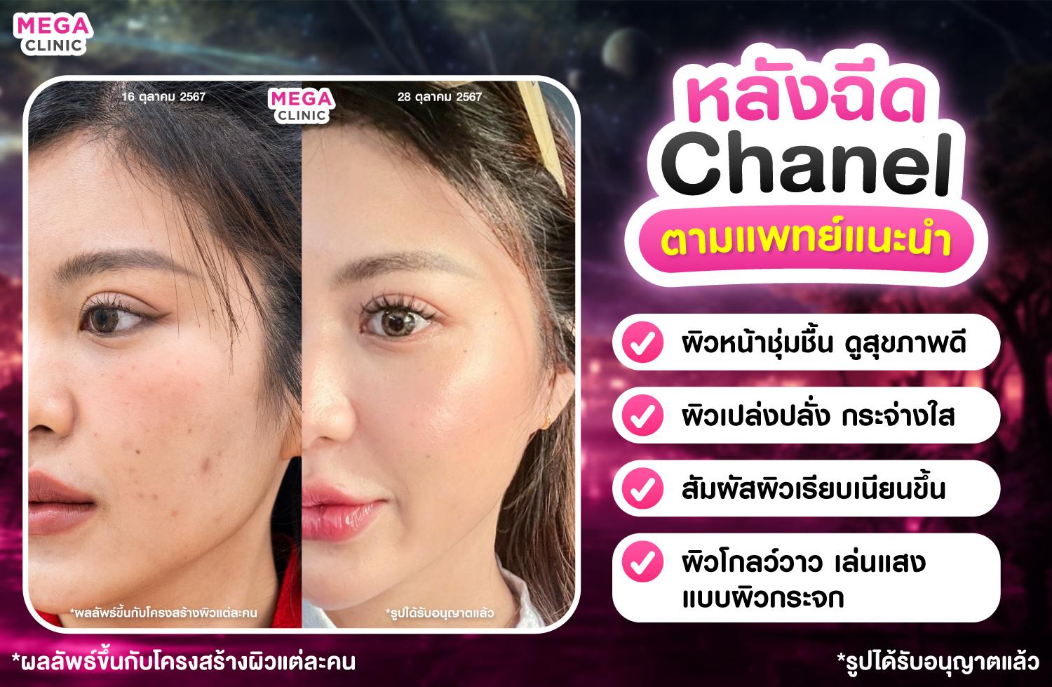 รีวิวผิวกระจก Meso Chanel เมโสชาแนล ฉีดหน้าใส