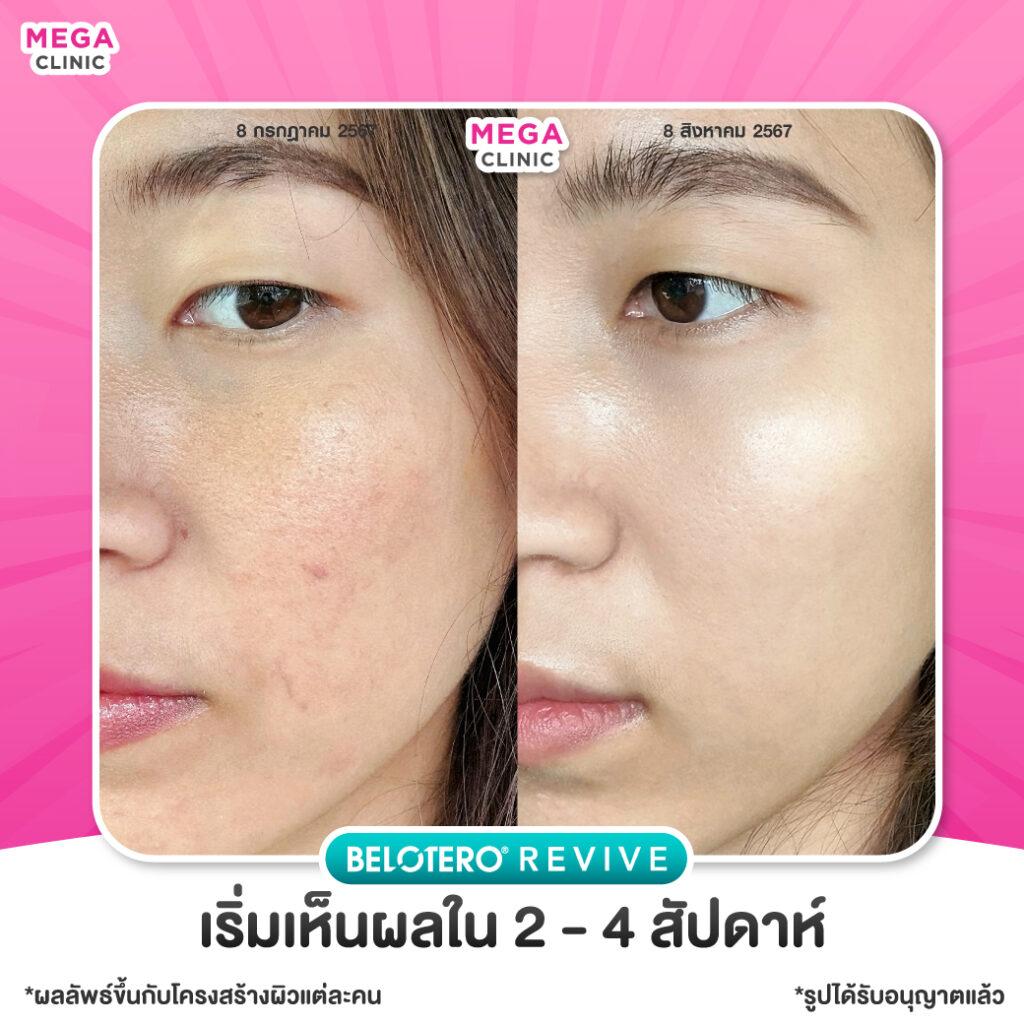 รีวิว Belotero Revive