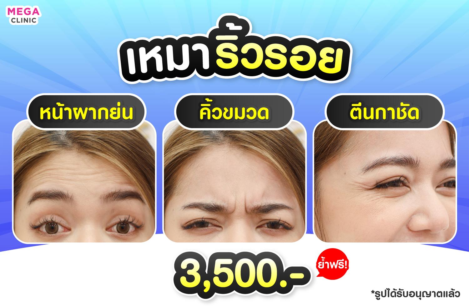 ริ้วรอยที่พบได้บ่อย