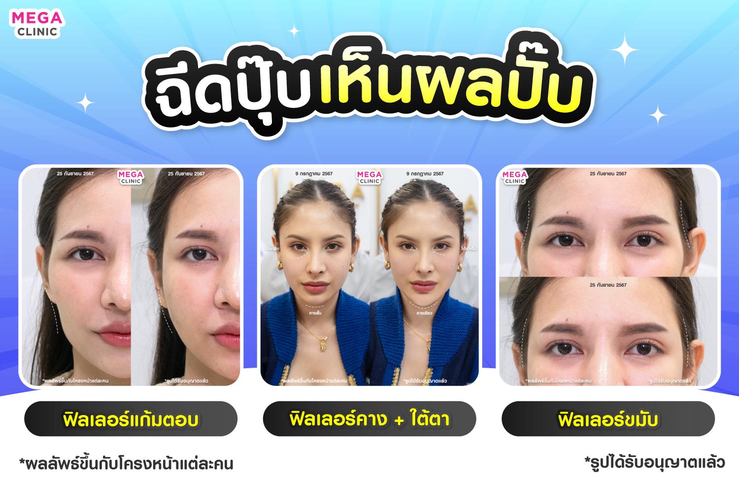 รีวิวฉีดฟิลเลอร์