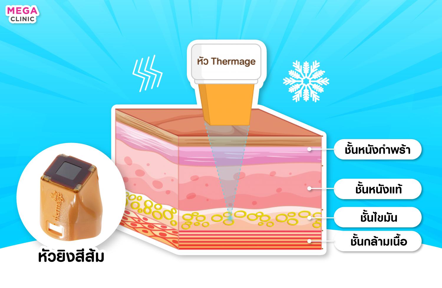 การทำงานของ Thermage