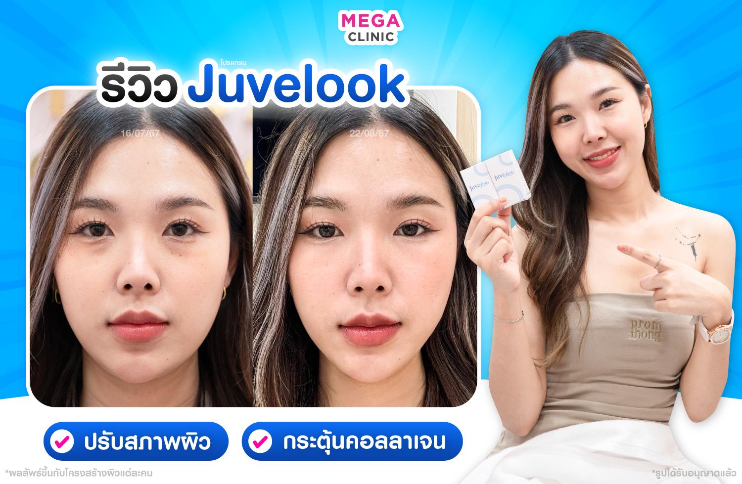 หัตถการ Juvelook เก็บร่องลึก กระตุ้นสร้างคอลลาเจน