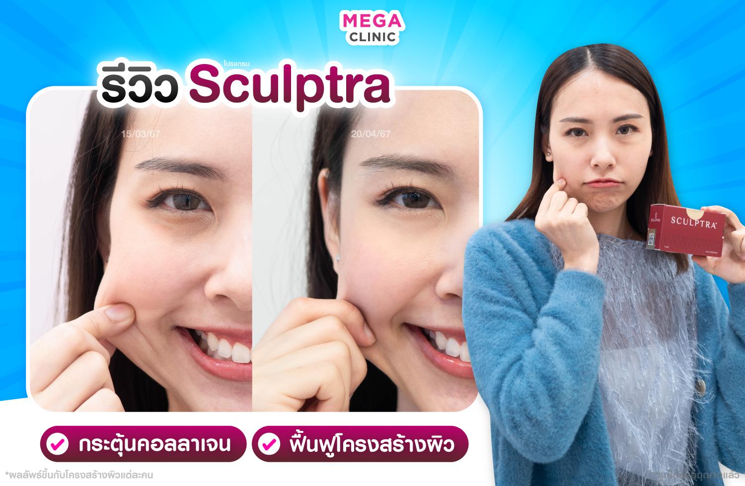 Sculptra กระตุ้นคอลลาเจน ฟื้นฟูโครงสร้างผิว