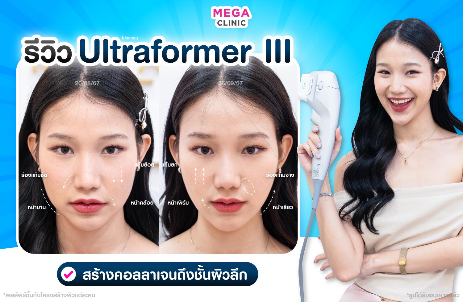 Ultraformer III ยกกระชับผิว กระตุ้นคอลลาเจน