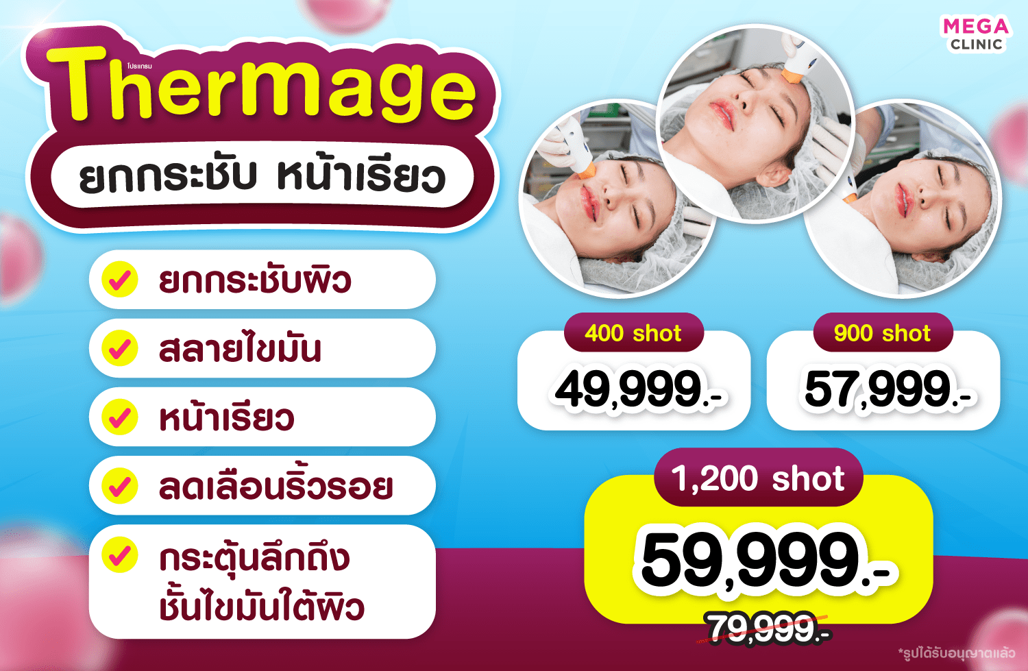 สรรพคุณ+ราคา Thermage