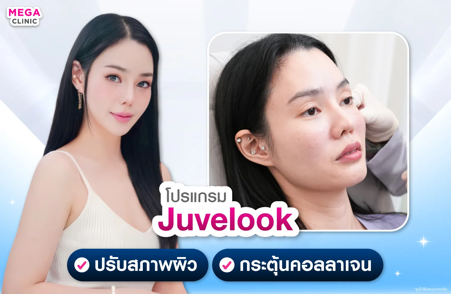 Juvelook ช่วยเก็บร่องลึก กระตุ้นการสร้างคอลลาเจน