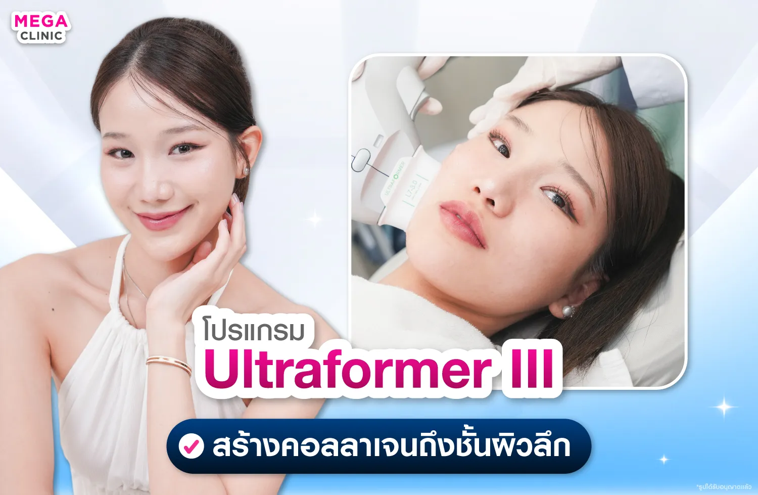 Ultraformer III ยกกระชับผิวพร้อมกระตุ้นคอลลาเจน