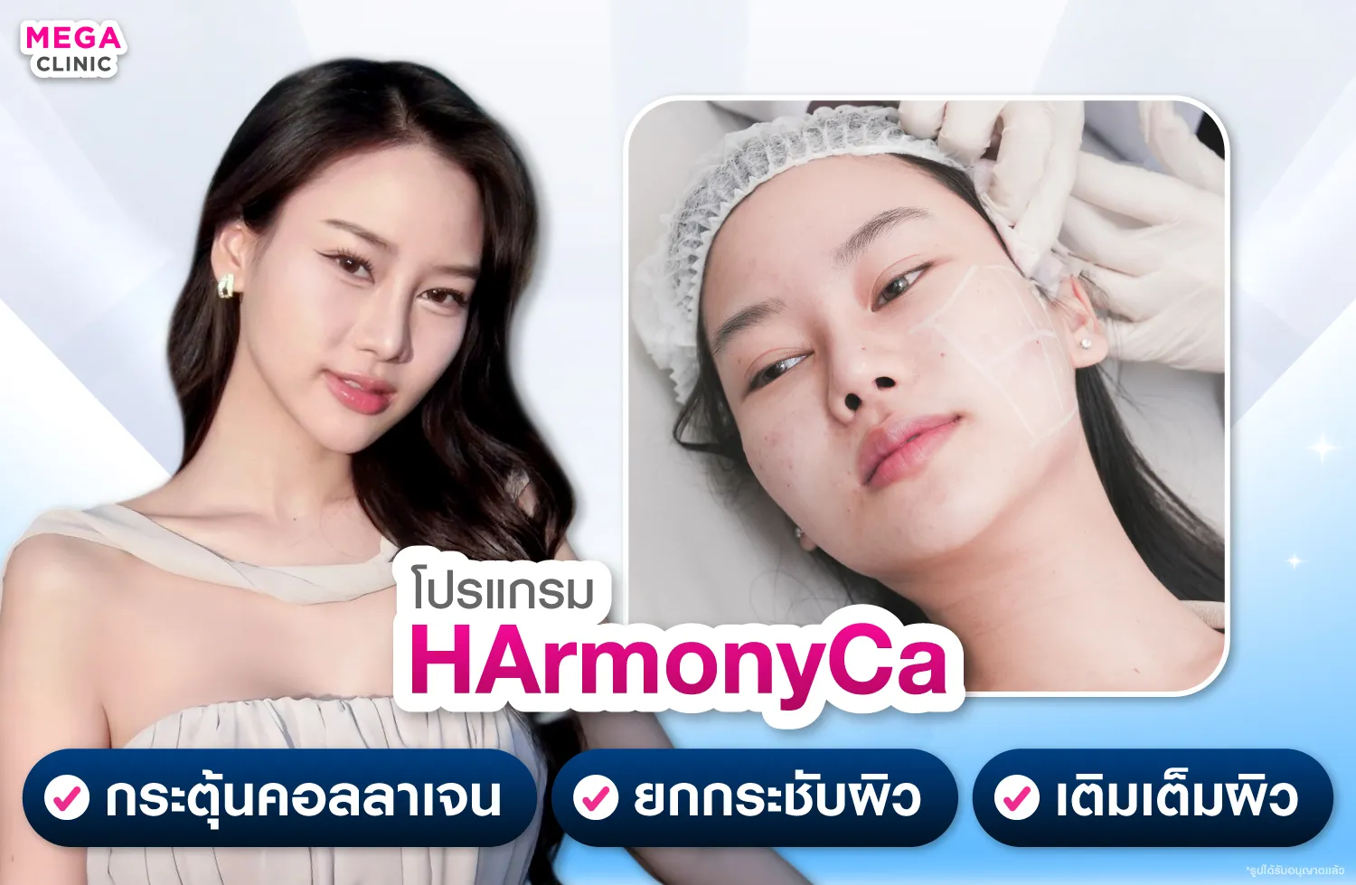 ฉีด HArmonyCa ยกกระชับผิว เติมเต็ม และฟื้นฟูโครงสร้างผิว