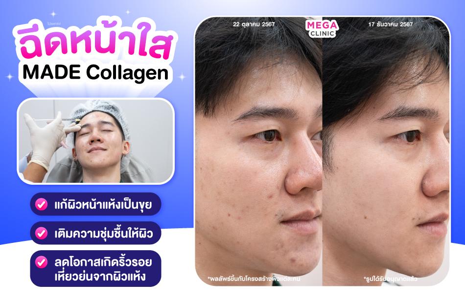 ฉีดหน้าใส MADE Collagen