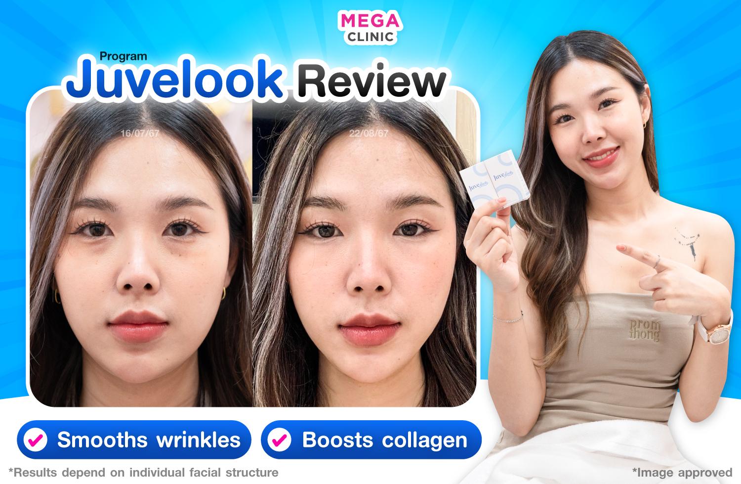 หัตถการ Juvelook เก็บร่องลึก กระตุ้นสร้างคอลลาเจน