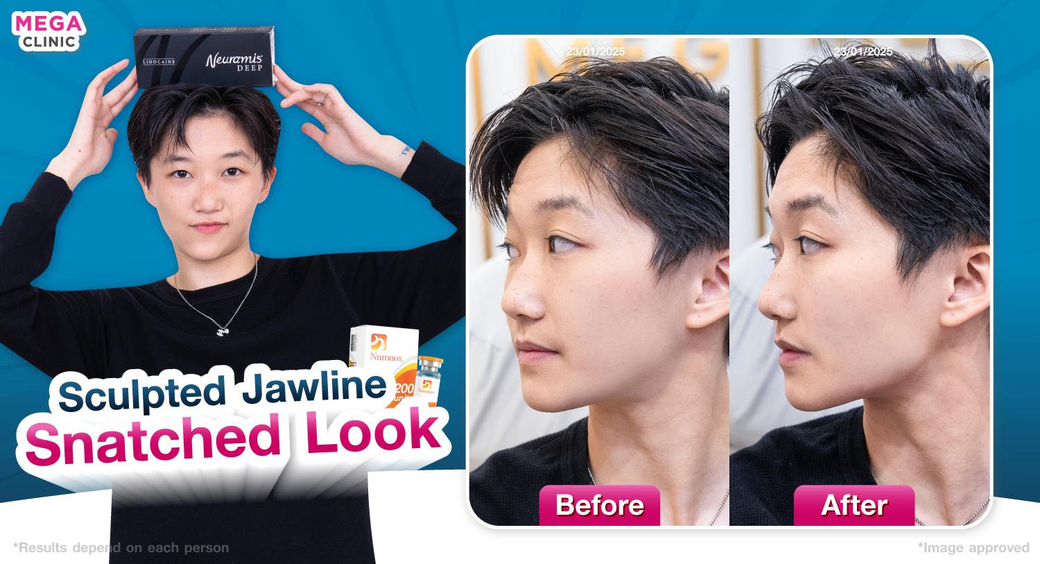 โบท็อกกราม ลดกราม หน้าเรียว กรอบหน้าชัด สันกรามชัด