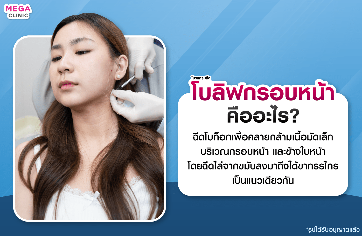 โบลิฟกรอบหน้า คืออะไร