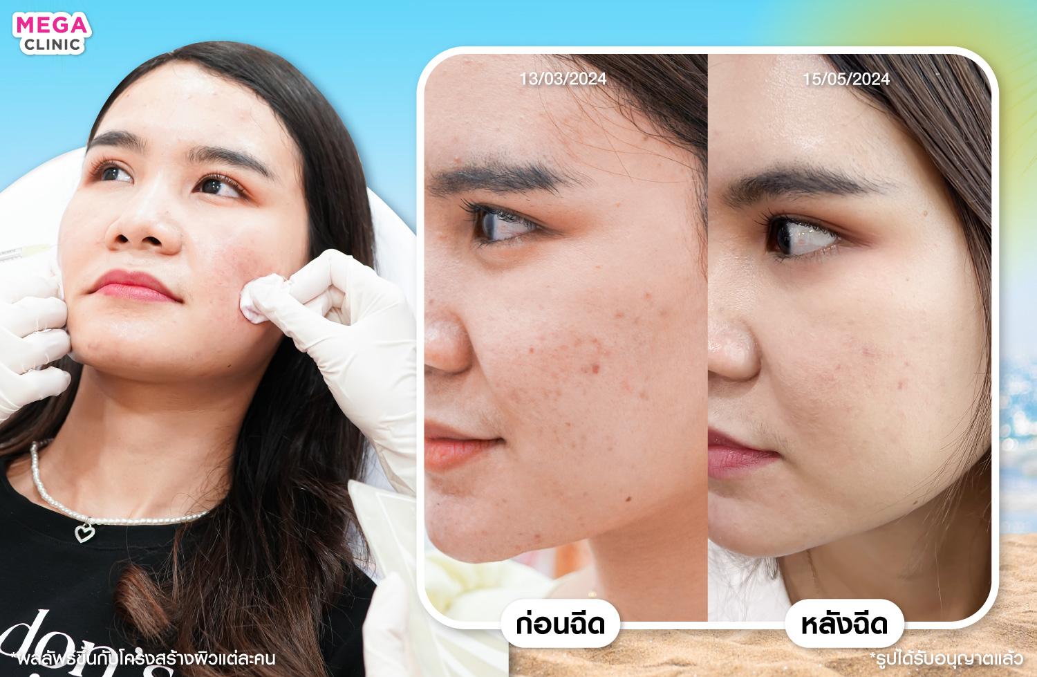 ขณะฉีด AuraWhite และ ภาพก่อน-หลังฉีด