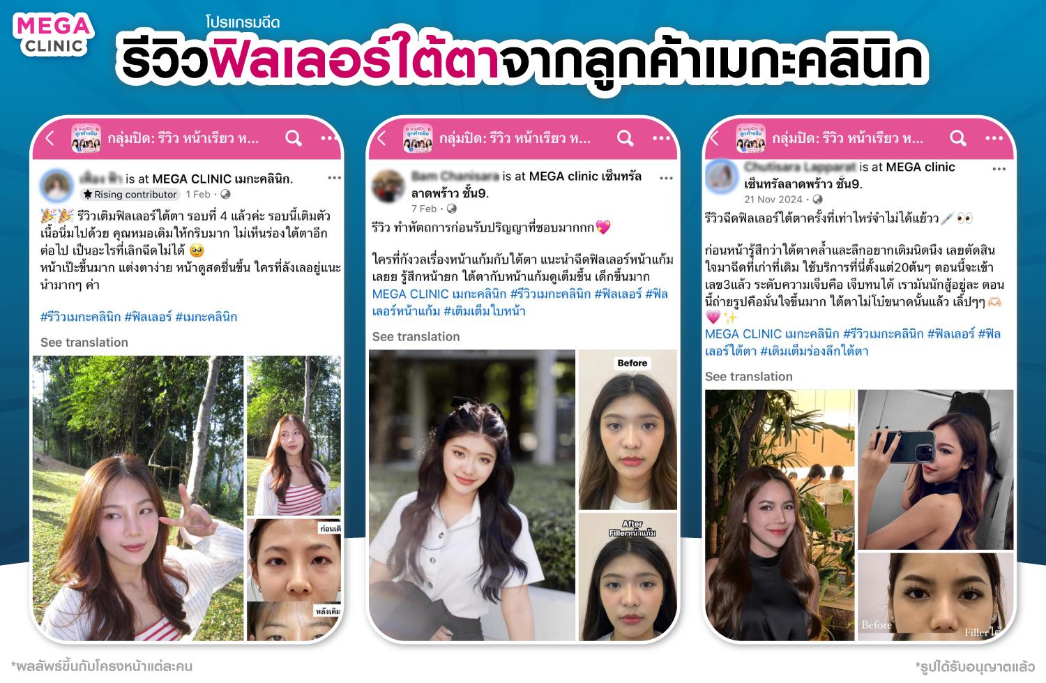 รีวิวฟิลเลอร์ใต้ตา