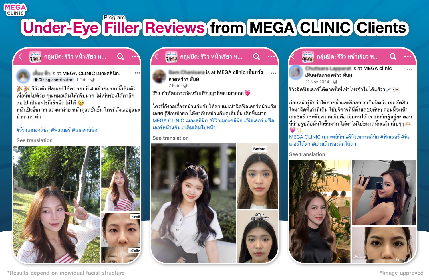 รีวิวฟิลเลอร์ใต้ตา