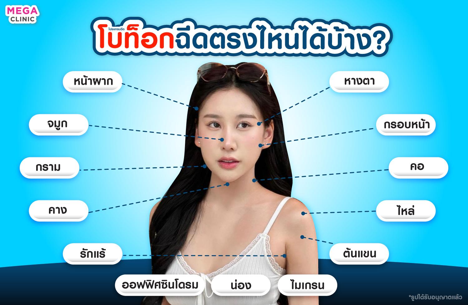 ฉีดโบท็อกฉีดตรงไหนบ้าง?