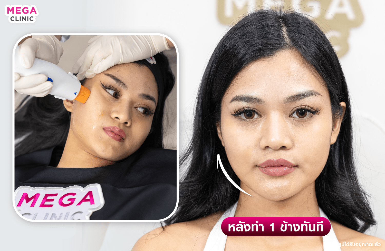 รีวิวหลังทำ โอริจิโอ้