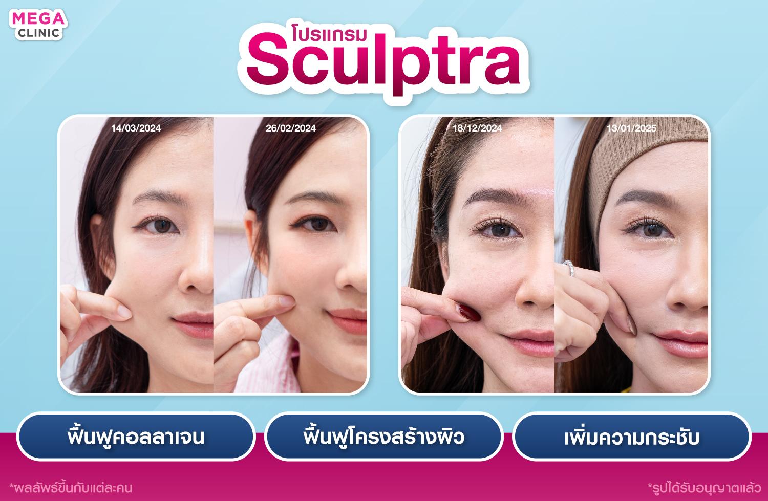 sculptra ช่วยอะไร