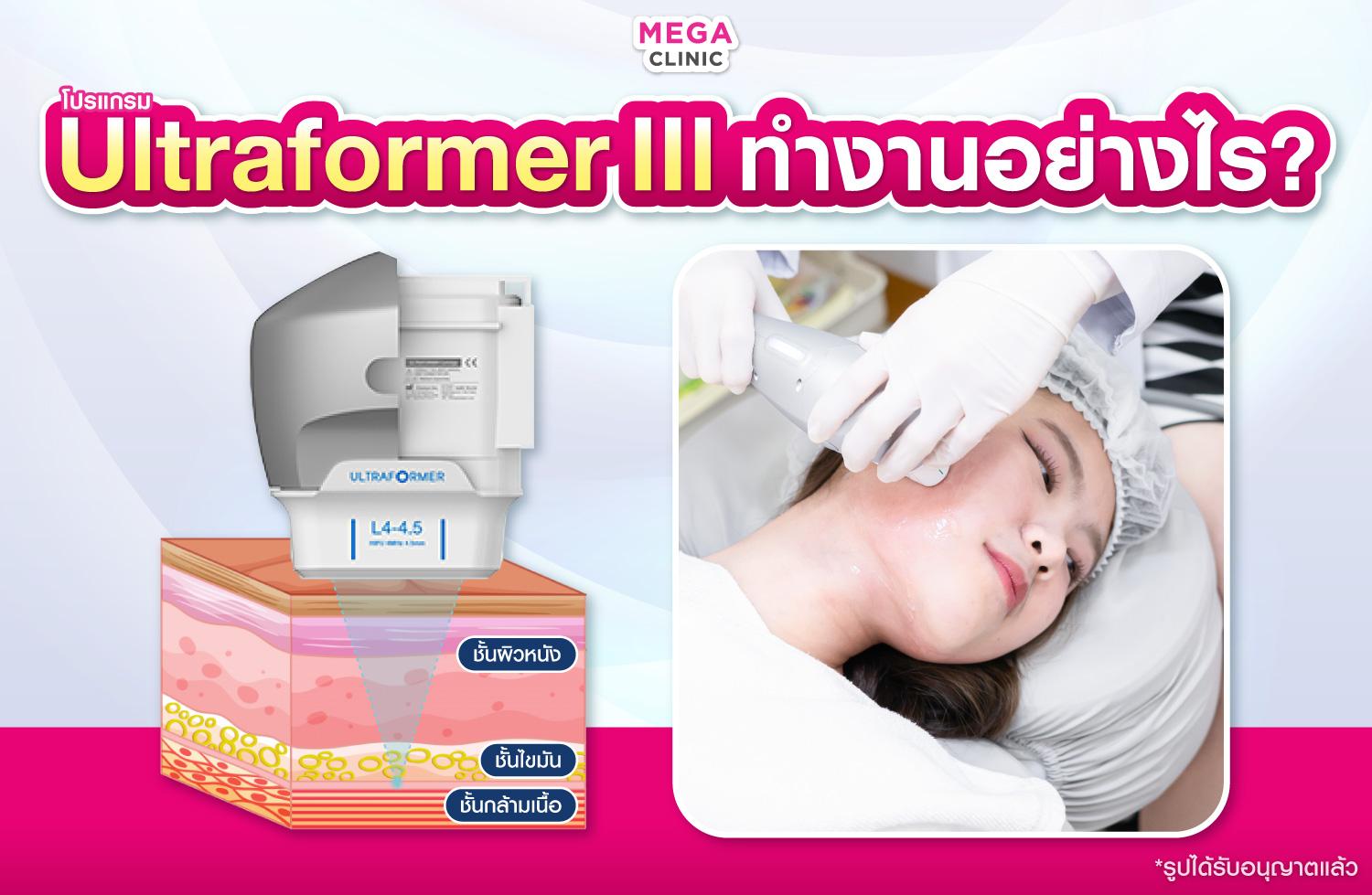 ทำงานของ Ultraformer III