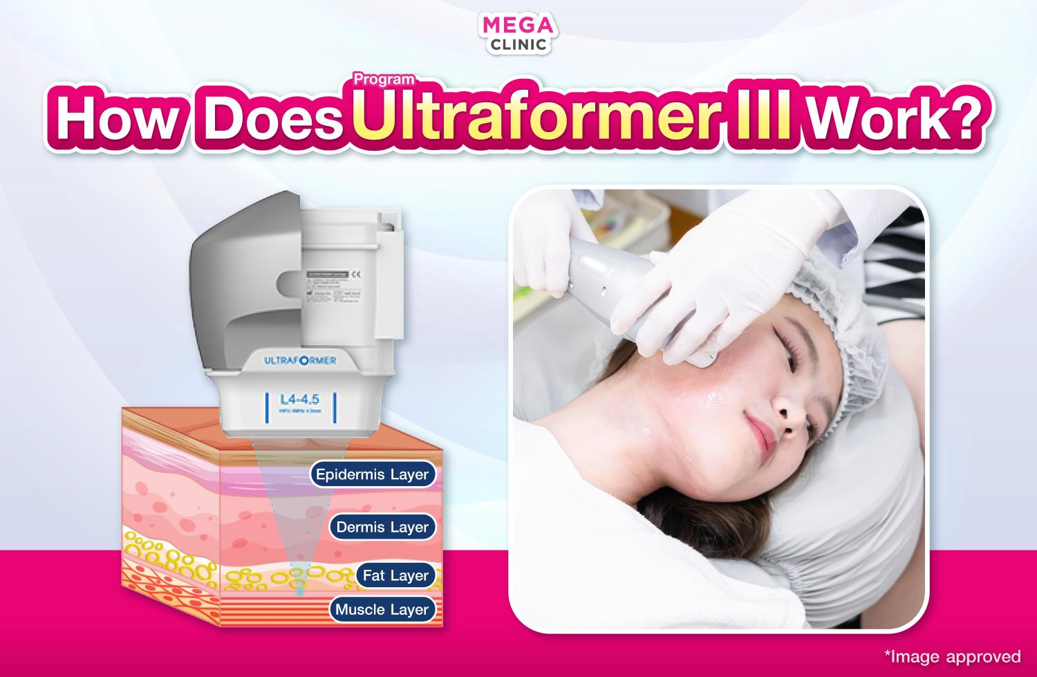 ทำงานของ Ultraformer III