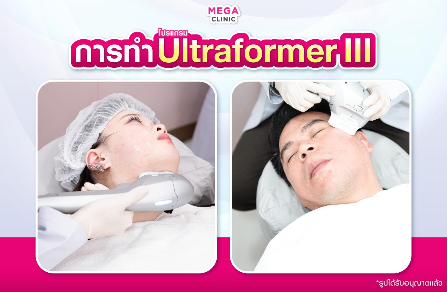 การทำ Ultraformer III