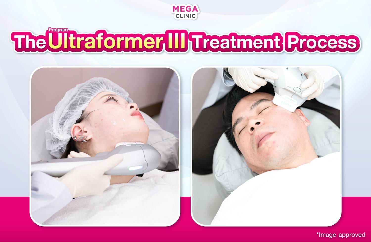 การทำ Ultraformer III