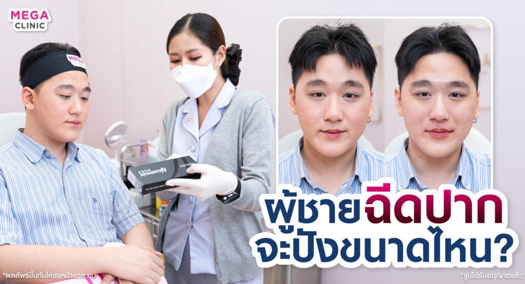 ฟิลเลอร์ปาก Neuramis ปรับทรงปากผู้ชาย