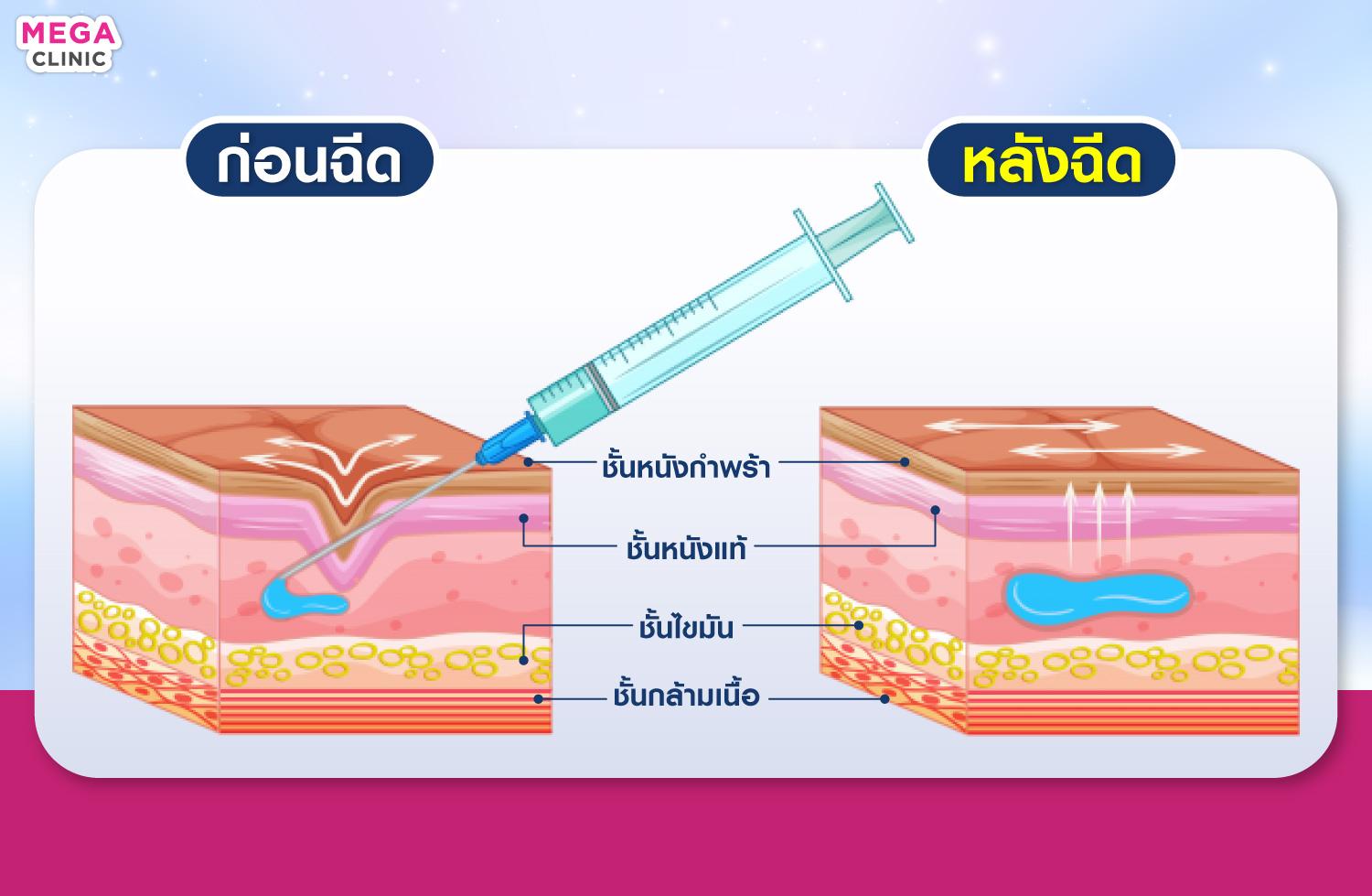 การทำงานของการ ฉีดฟิลเลอร์