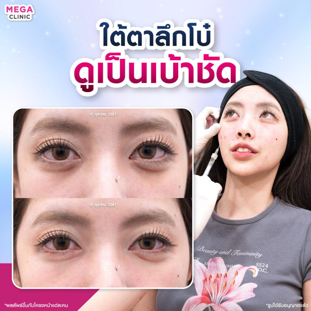 ก่อน และหลังการ ฉีดฟิลเลอร์ ใต้ตา แก้ใต้ตาลึกโบ๋