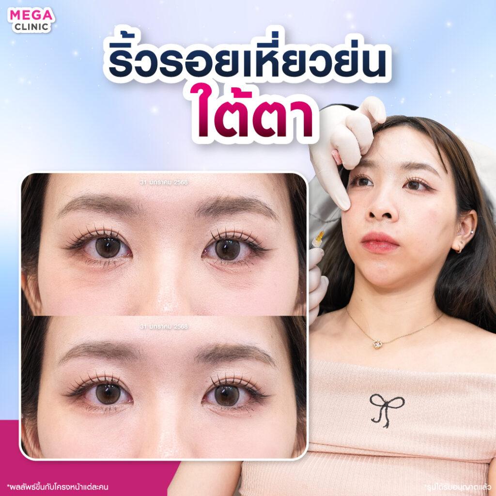 ก่อน และหลังการ ฉีดฟิลเลอร์ ใต้ตา แก้ปัญหาริ้วรอยเหี่ยวย่น