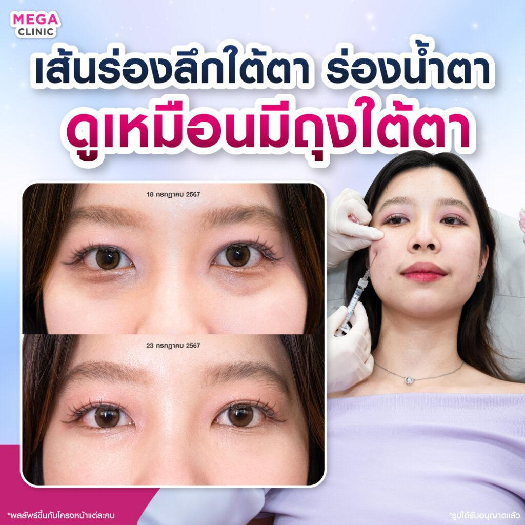 ก่อน และหลังการ ฉีดฟิลเลอร์ ใต้ตา ลดเส้นร่องลึกใต้ตา