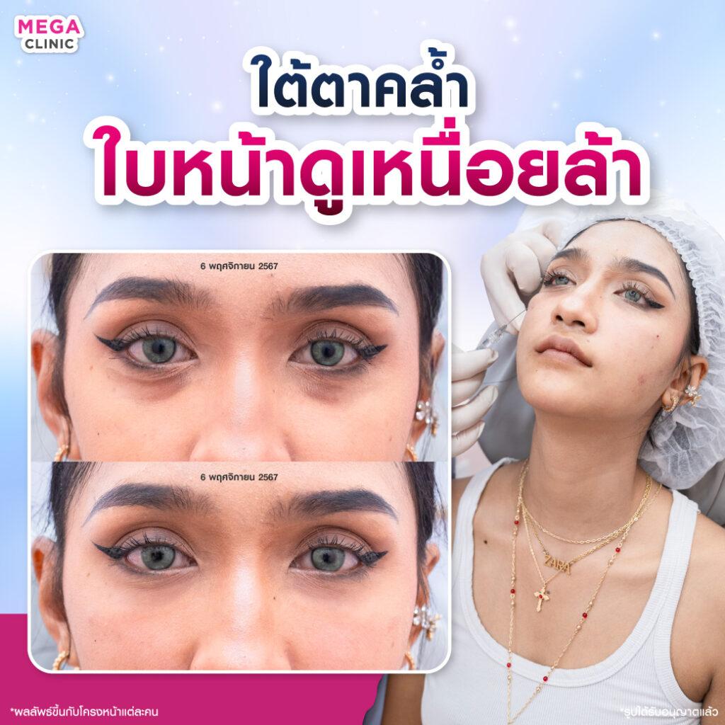 ก่อน และหลังการ ฉีดฟิลเลอร์ ใต้ตา แก้ใต้ตาคล้ำ