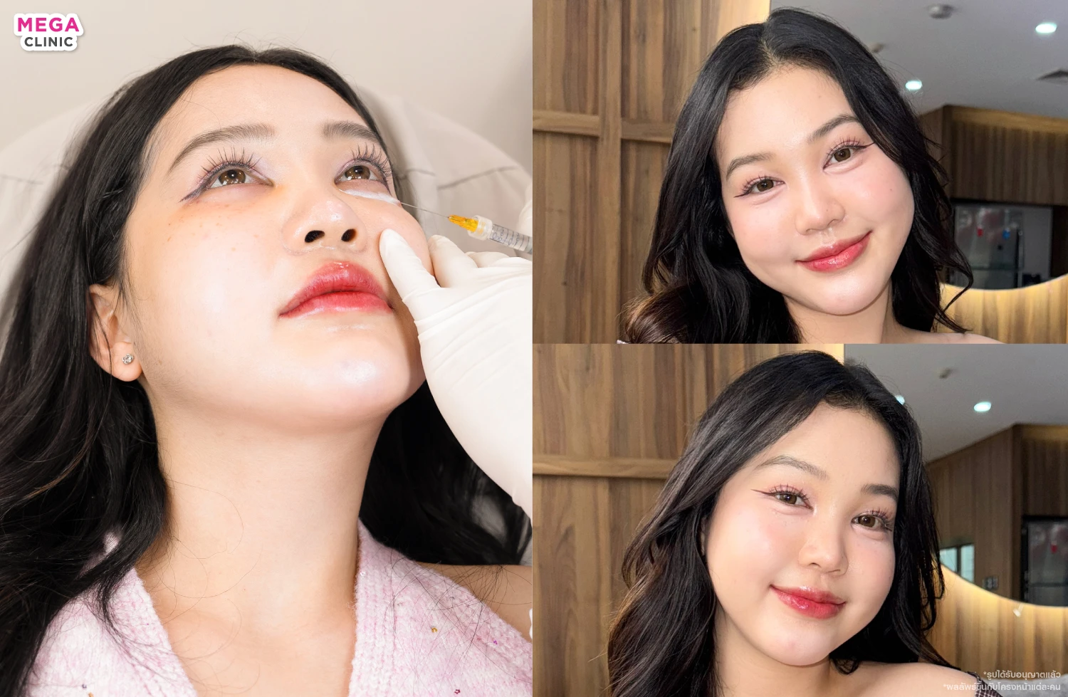 หลังฉีดดอลลี่อาย