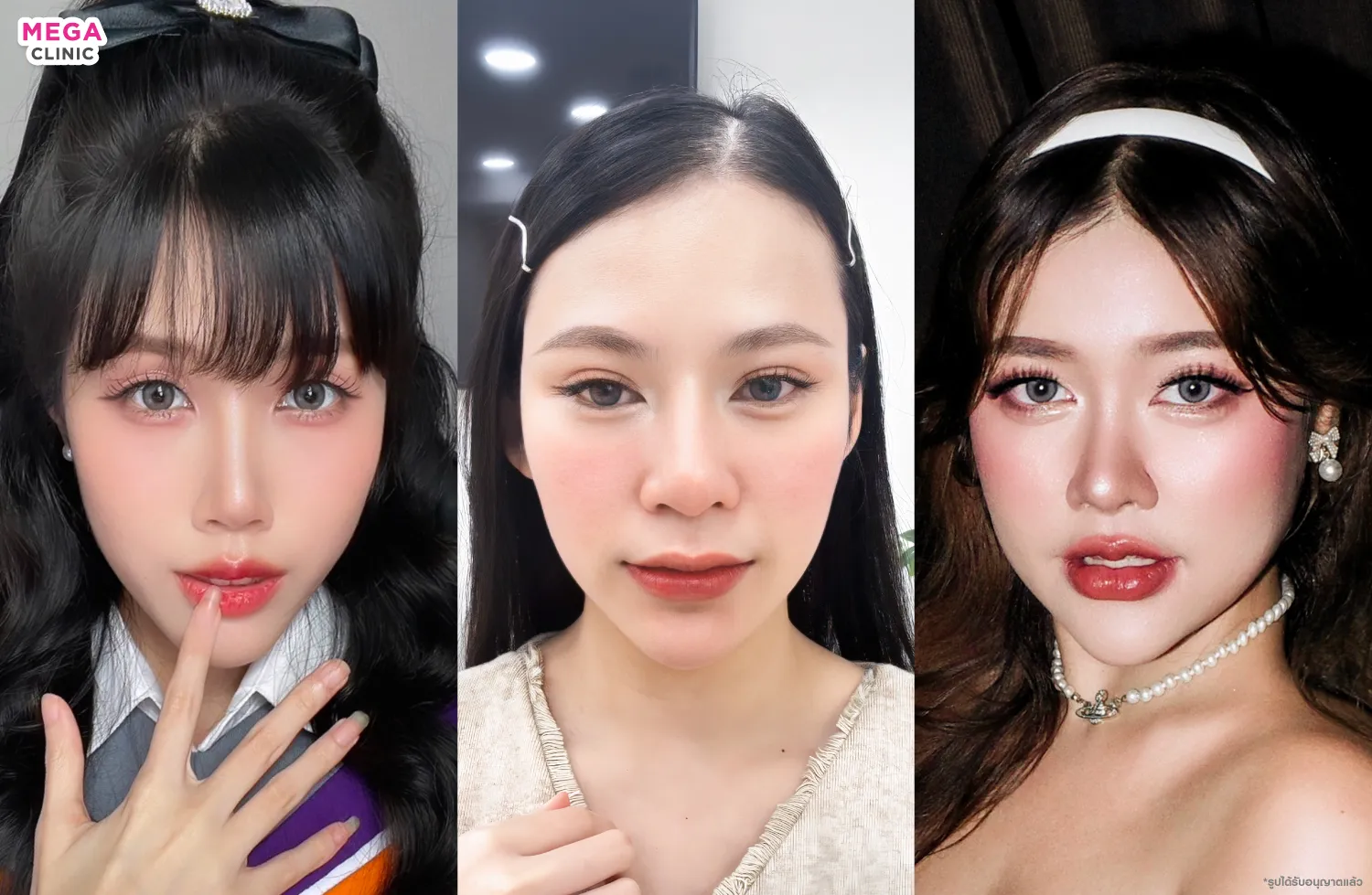 รีวิว ฉีดดอลลี่อาย