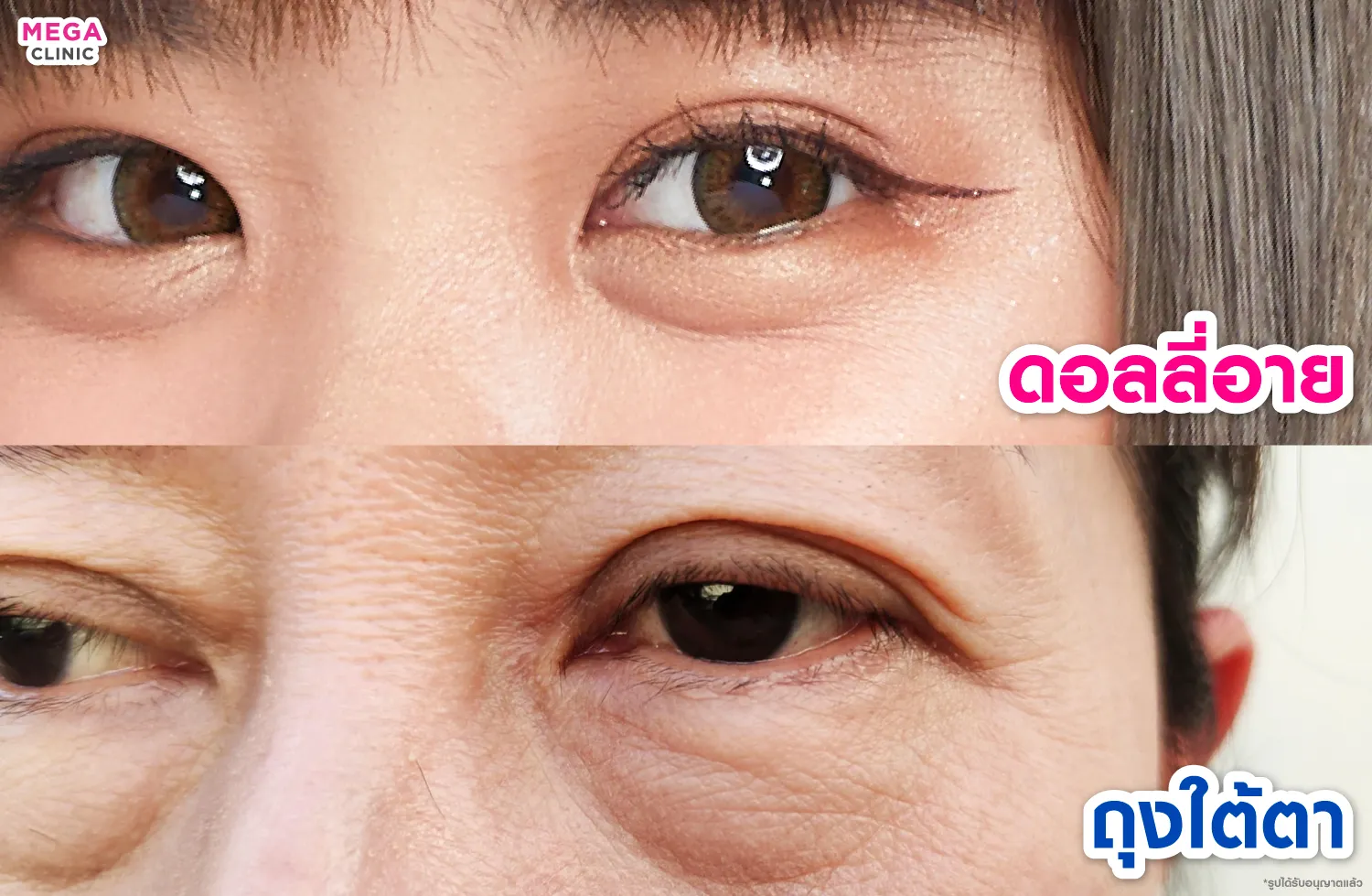 ดอลลี่อาย และถุงใต้ตา
