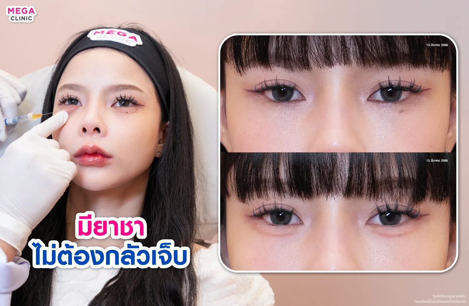ขณะฉีดดอลลี่อาย และภาพก่อน-หลังฉีดดอลลี่อาย