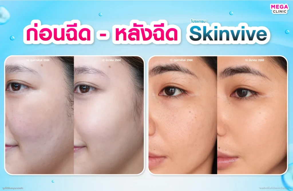 Skinvive รีวิว ก่อน-หลังฉีด