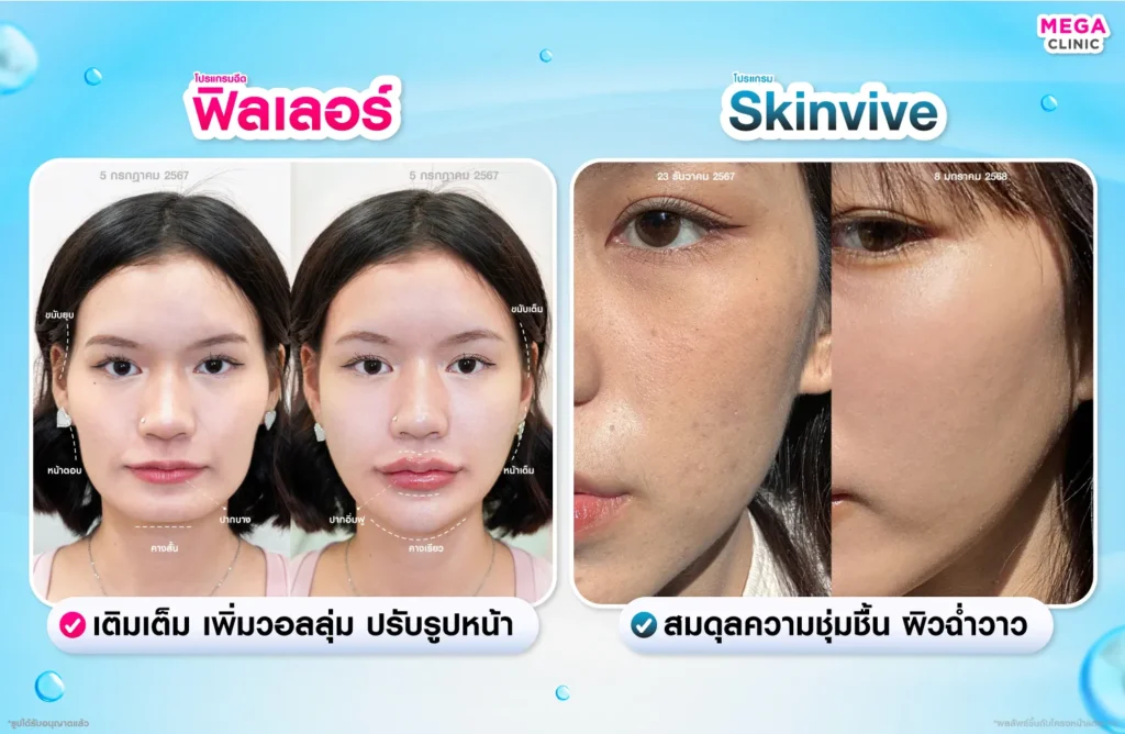 ก่อน และหลัง ฉีด ฟิลเลอร์ และ สกินวิฟฟ์