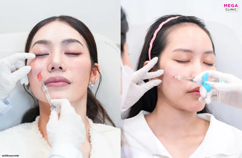 Skinvive ฉีดตรงไหน