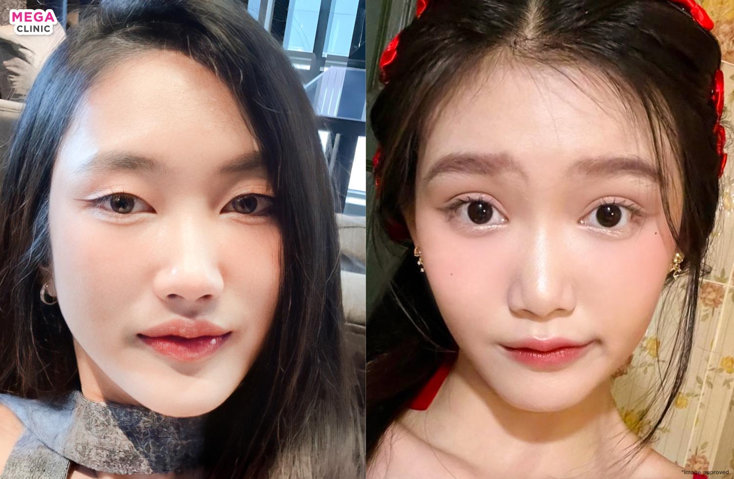 Before and after Dolly Eye injections