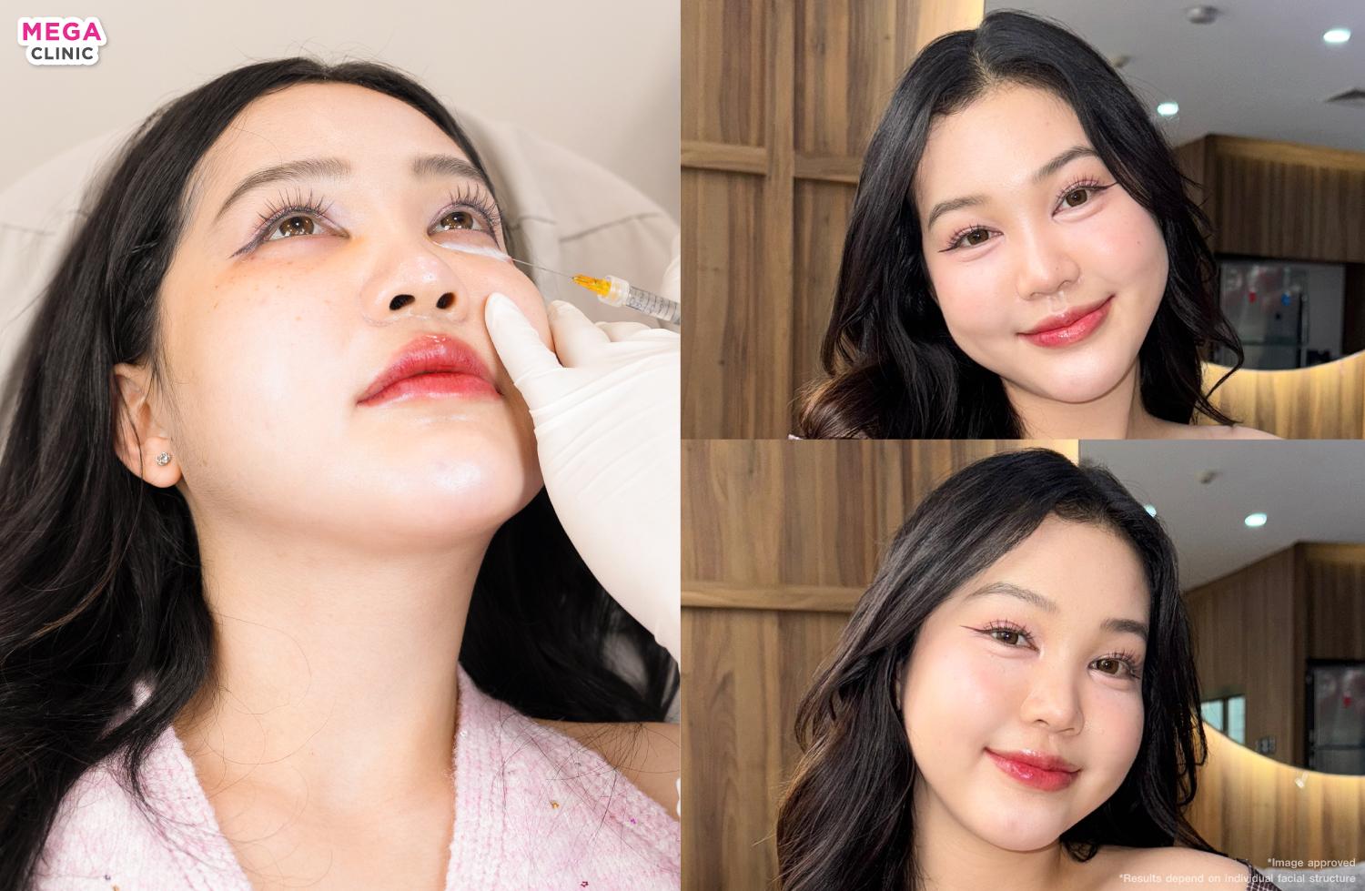 หลังฉีดดอลลี่อาย