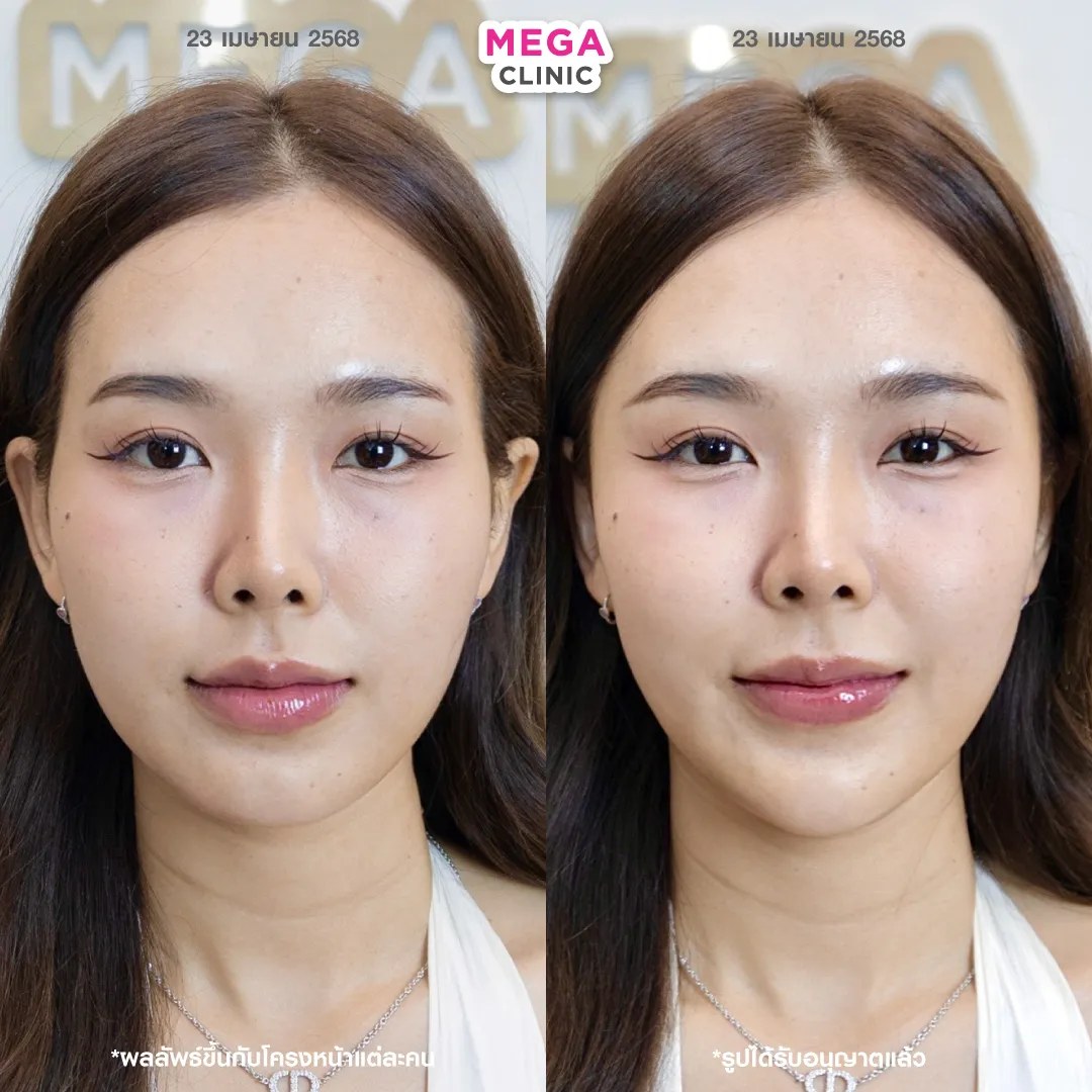 lipo c injection before and after 1 month Quick Results: Achieve a Slim Face in with These Injections! Melanotan-1 Peptide UK | melanotan ii Shade:01 Strawberry