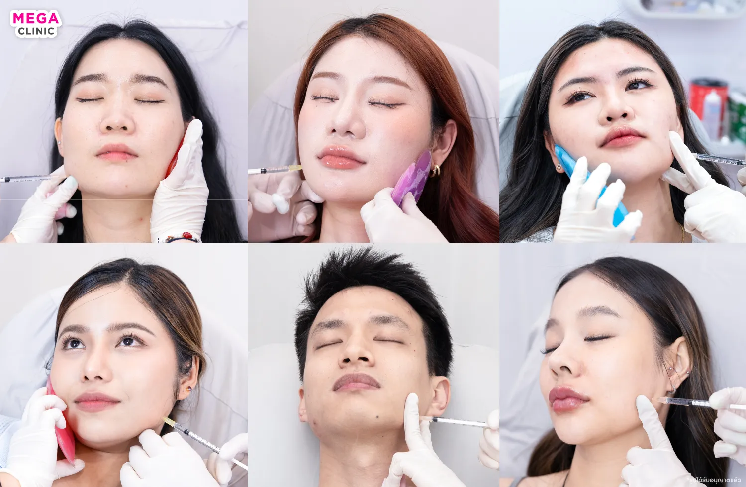 ฉีดโบท็อก ที่ MEGA CLINIC