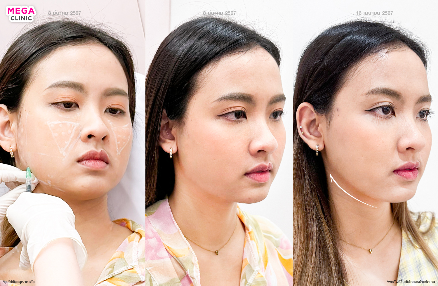 โบลิฟกรอบหน้า รีวิว