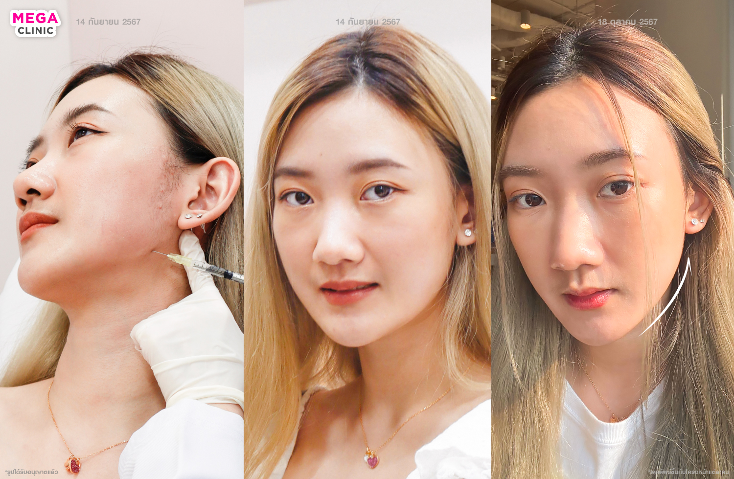 โบลิฟกรอบหน้า รีวิว