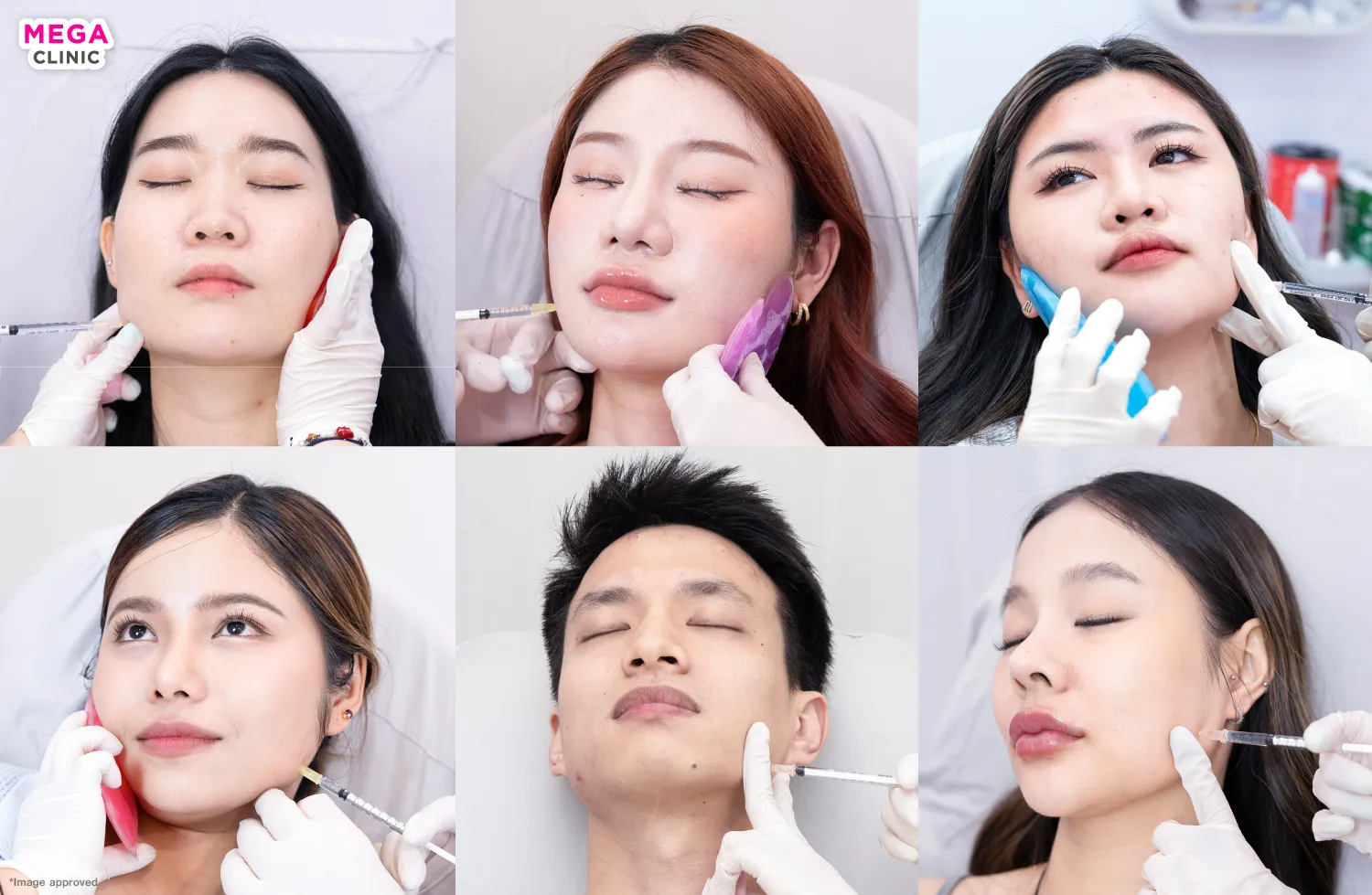 ฉีดโบท็อก ที่ MEGA CLINIC