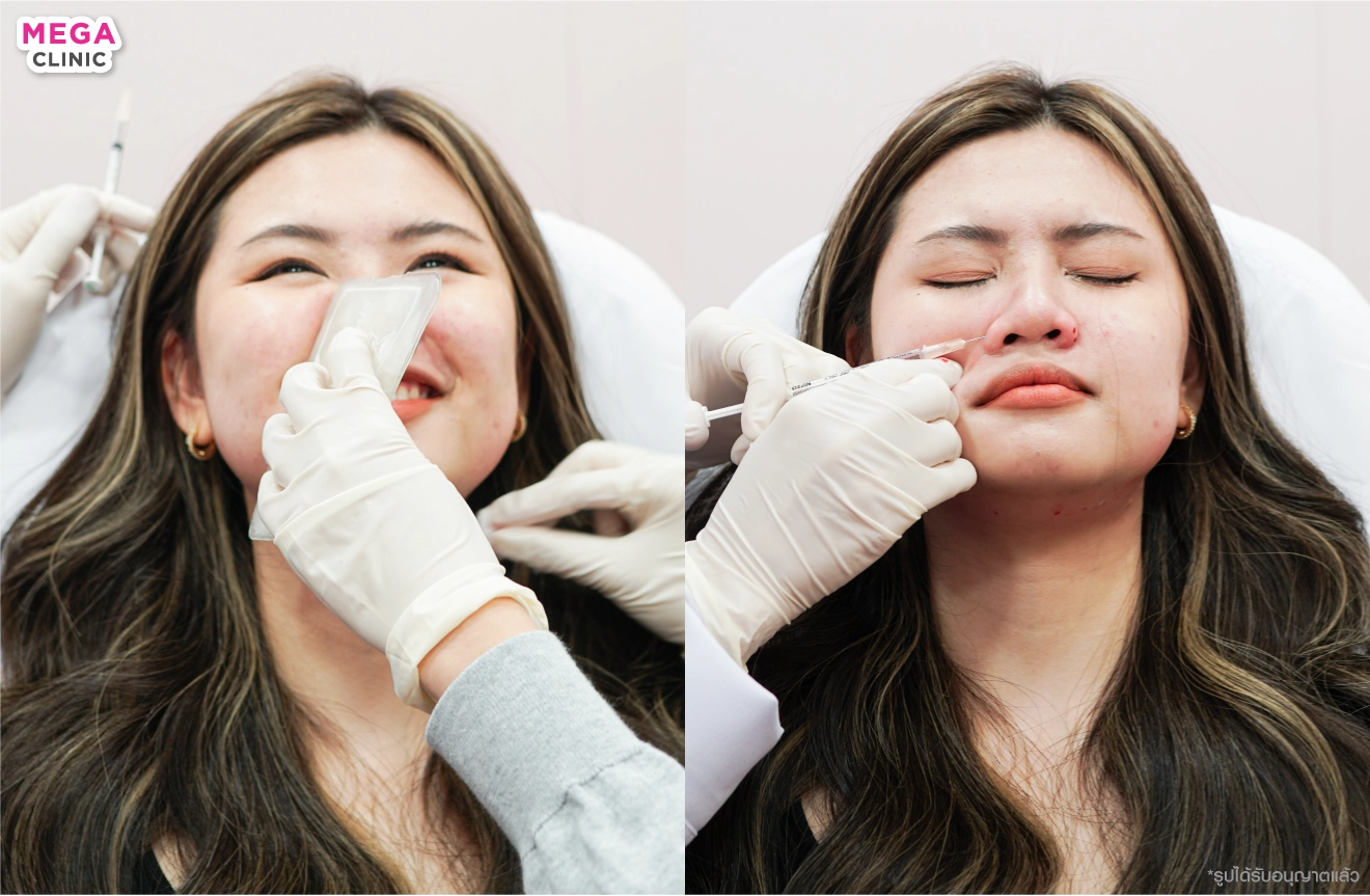 ฉีดโบท็อกปีกจมูก