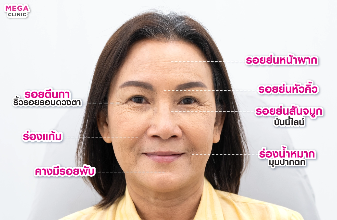ริ้วรอยคืออะไร